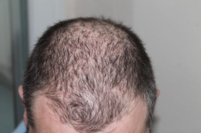 Santé capillaire et esthétique : comment retrouver une chevelure dense et harmonieuse ?